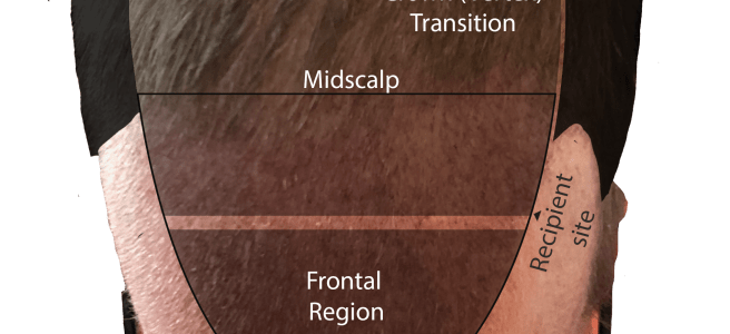 Birds eye view of scalp to show different regions: Frontal region, midscalp, crown (vertex), and donor-site