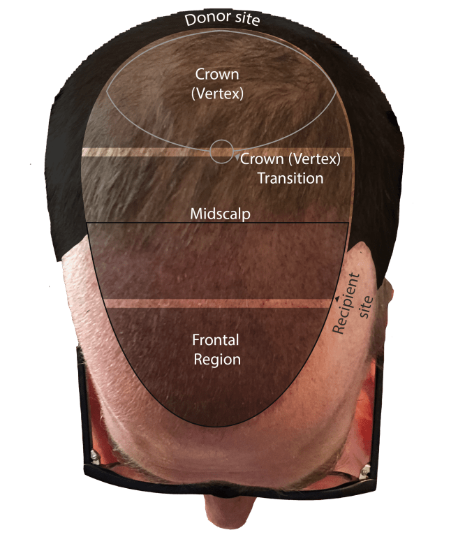 Birdseye view of my head with outline to show the frontal region, mid scalp, and crown (vortex) areas of hair loss.