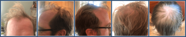 Showing different angles of my head to show current state of hair loss