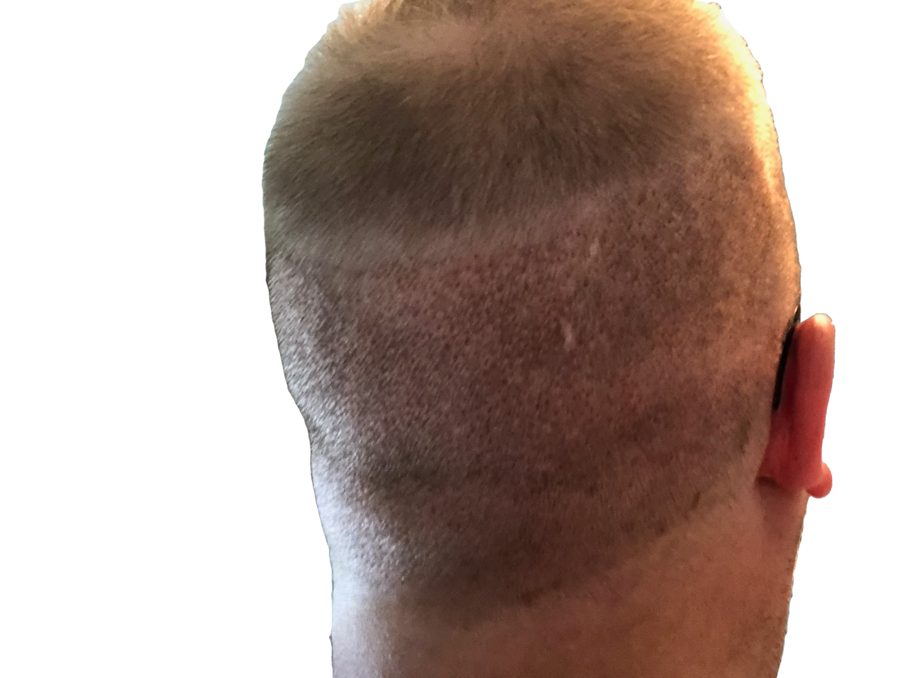 back side of head photo of me three days after a hair transplant