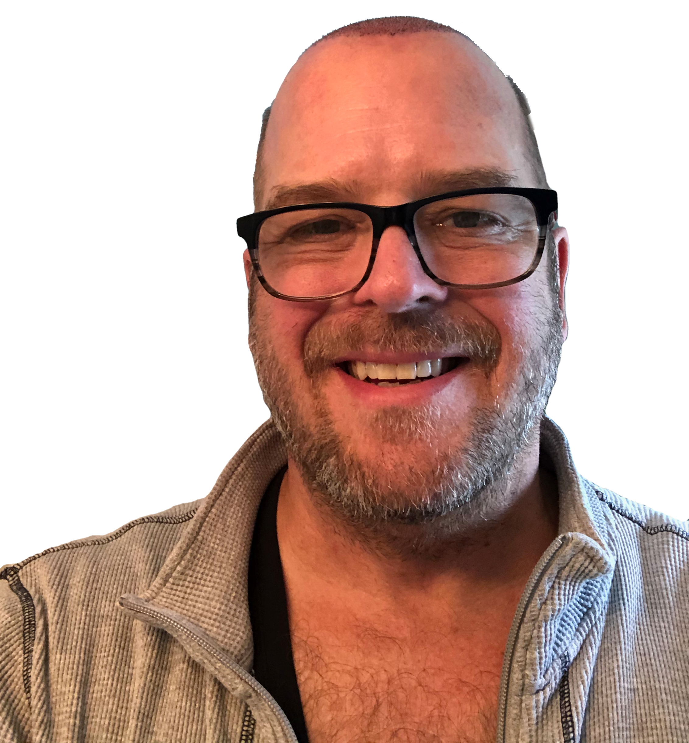 front photo of me three days after a hair transplant