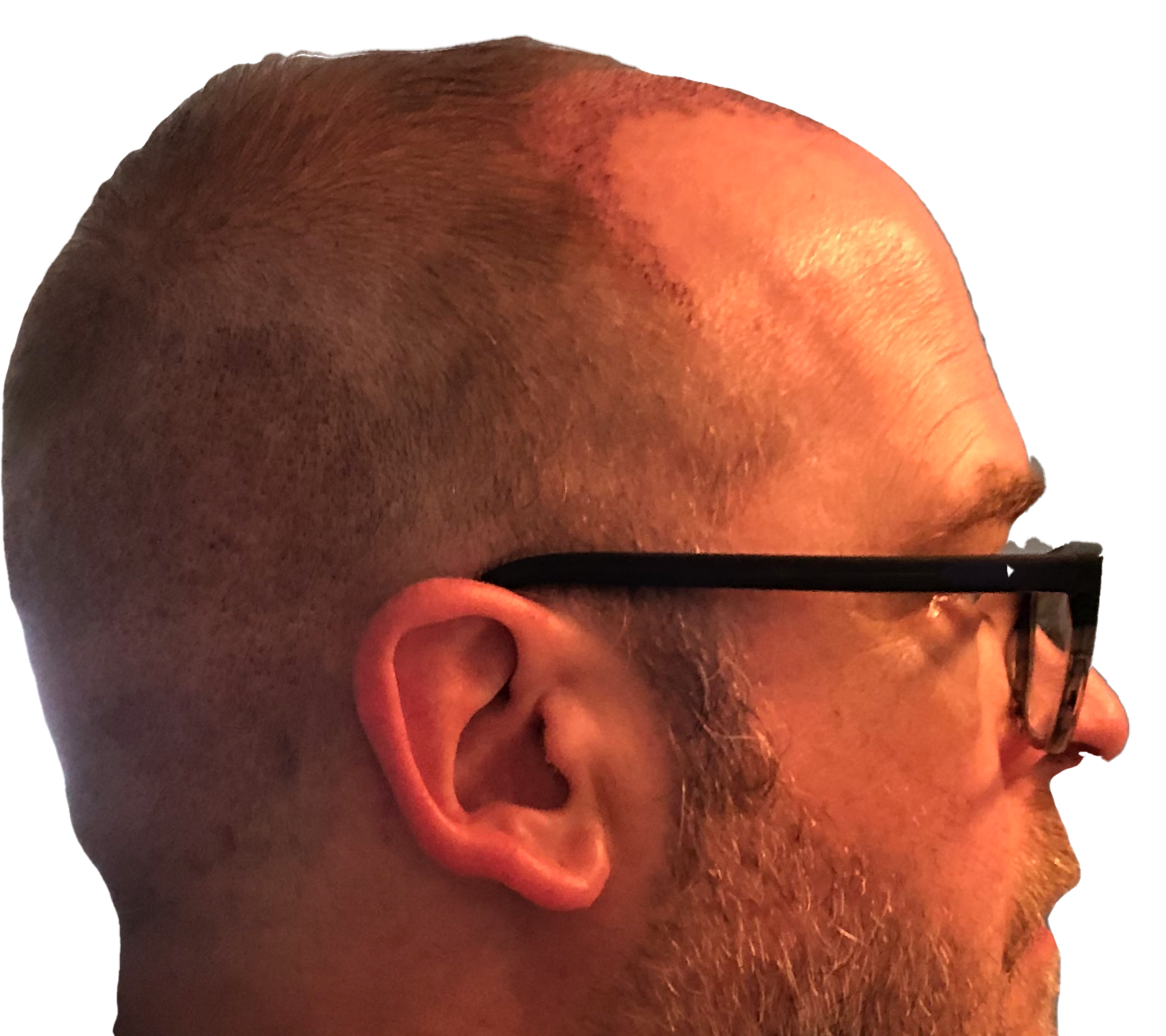right side of head photo of me three days after a hair transplant