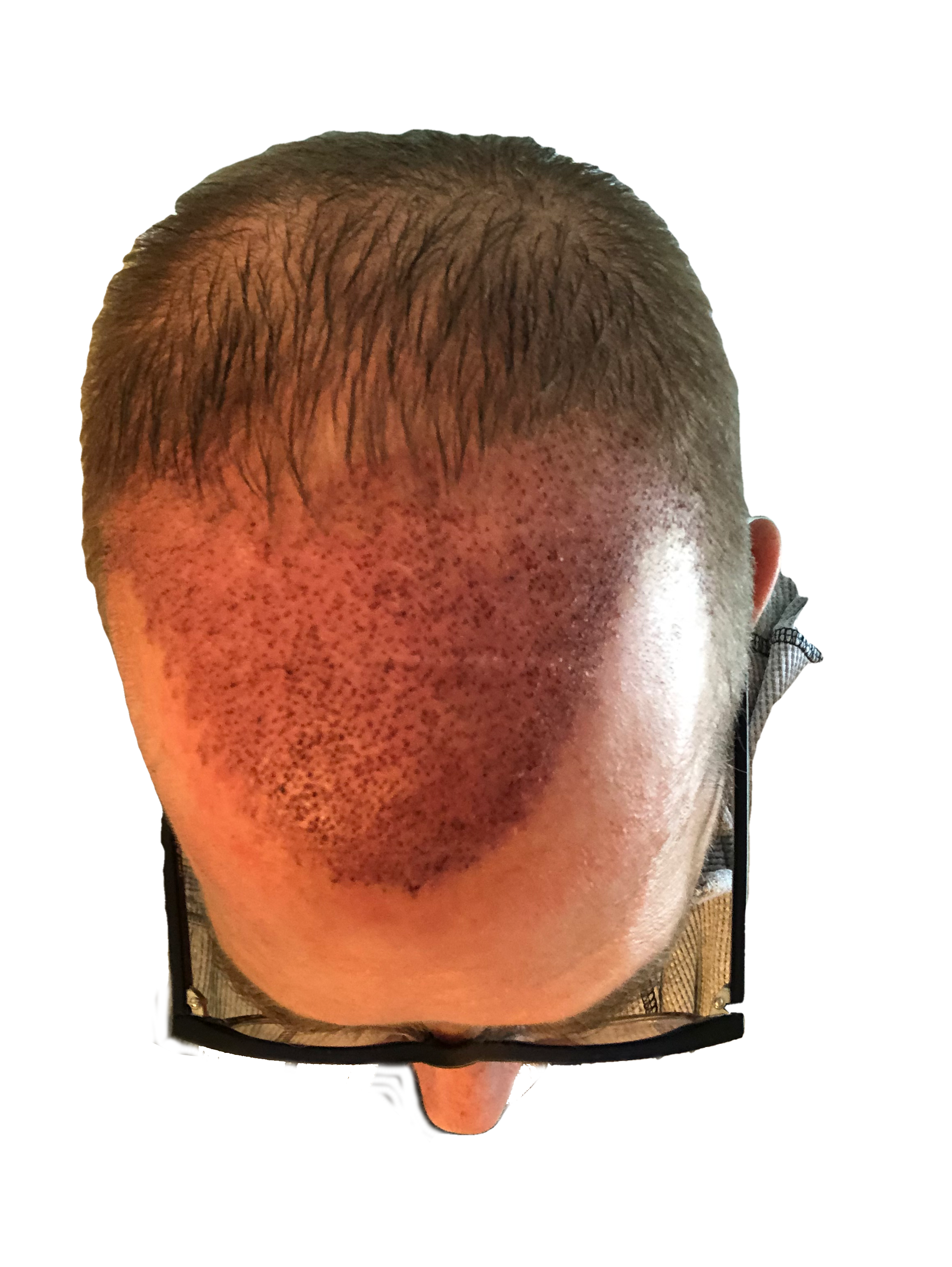 top of head photo of me three days after a hair transplant