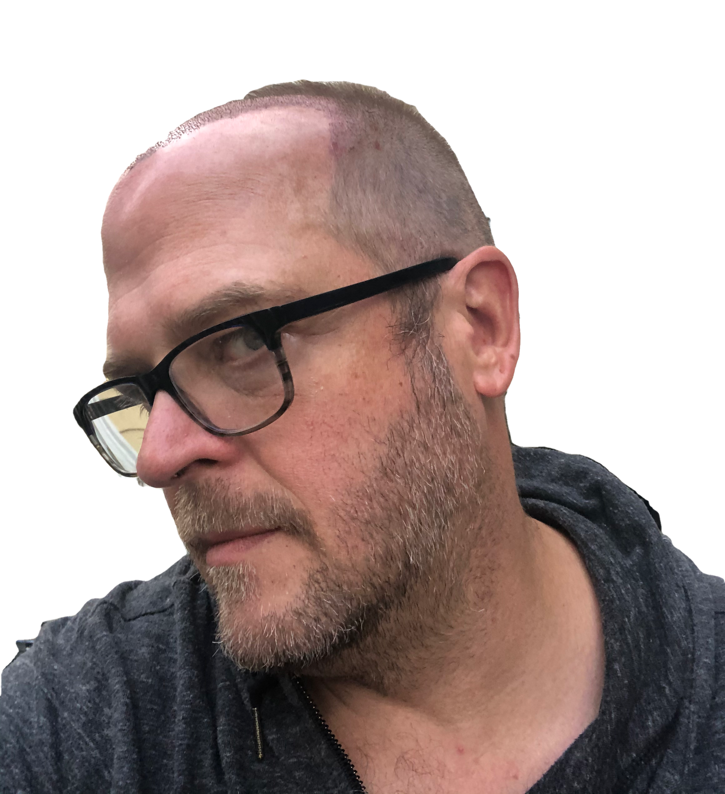 Left side of head two days after hair transplant