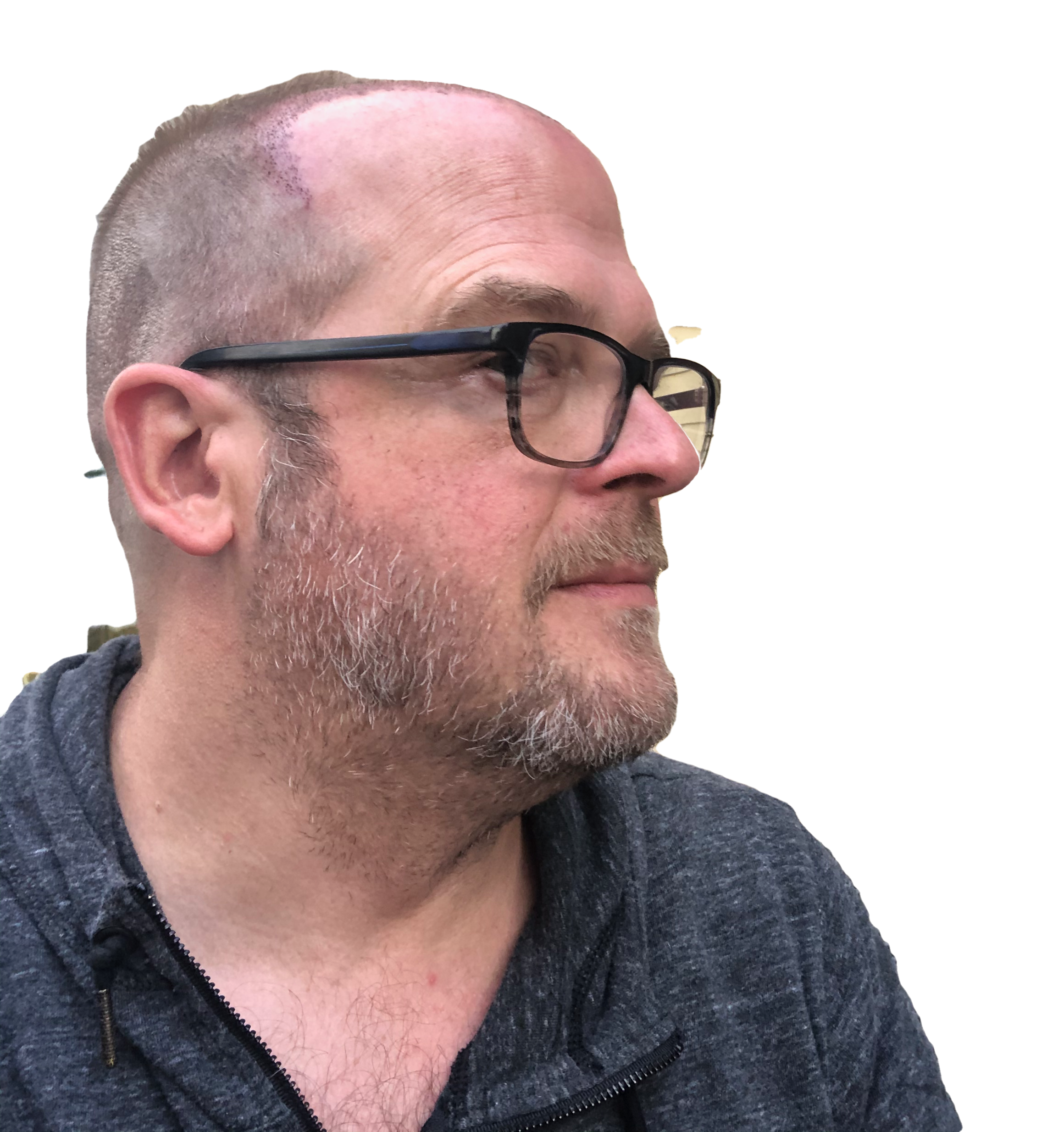 Right side of head two days after hair transplant