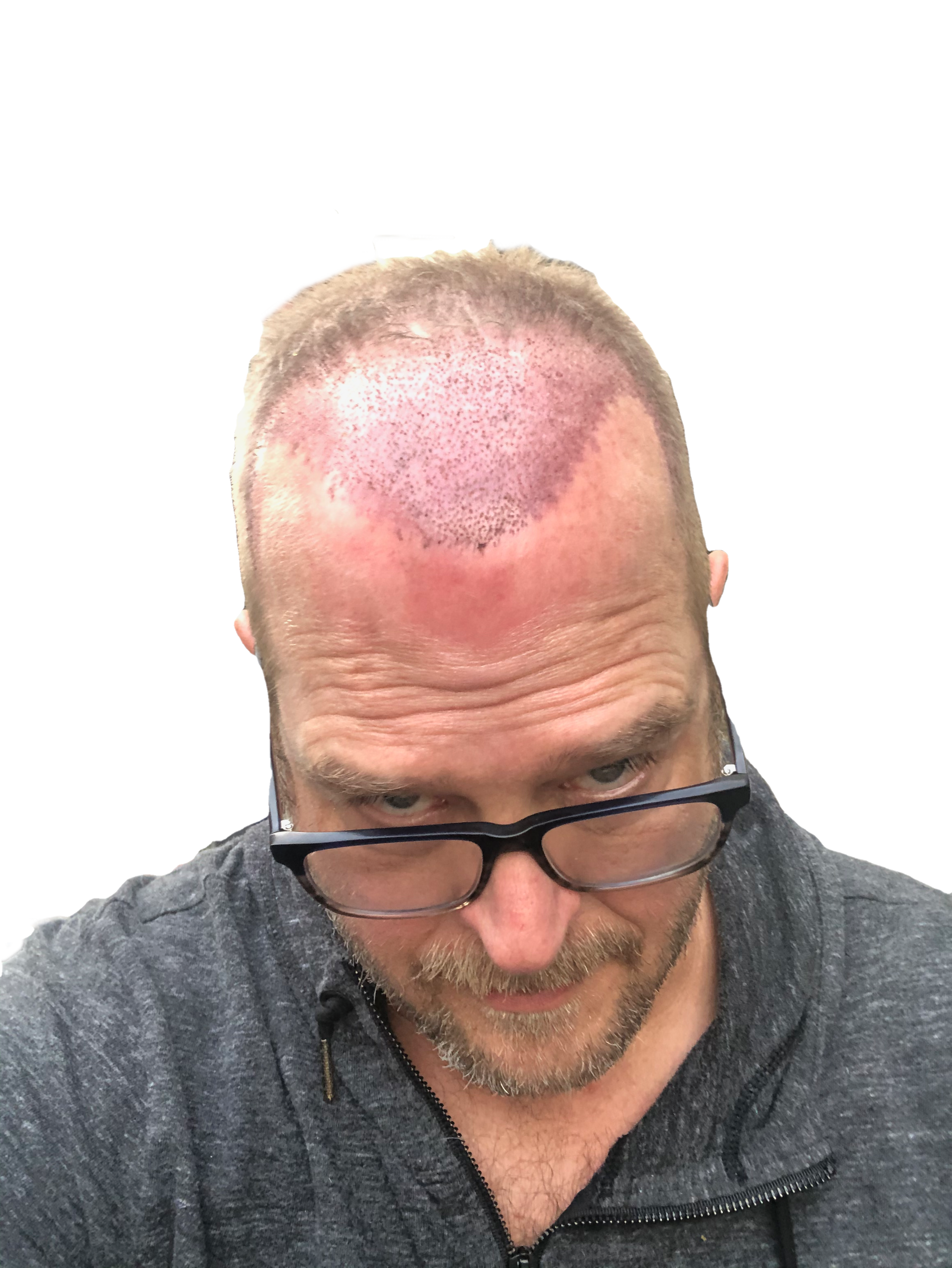 Top of head two days after hair transplant
