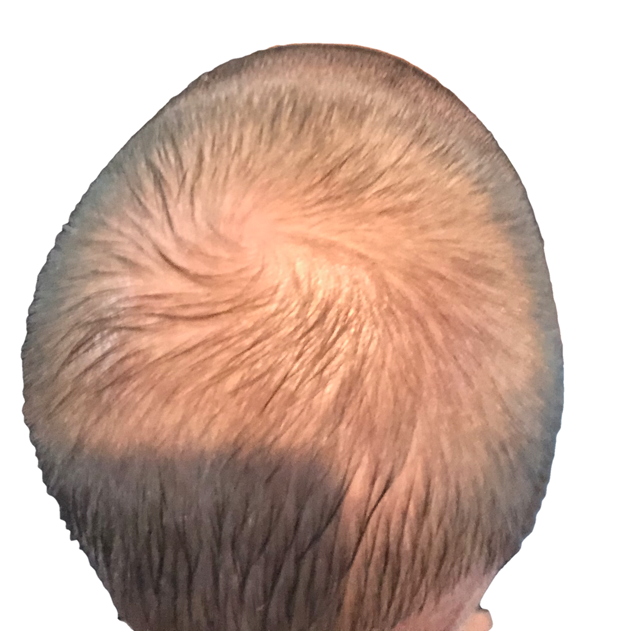 Photo of my crown showing progress four days after hair transplant