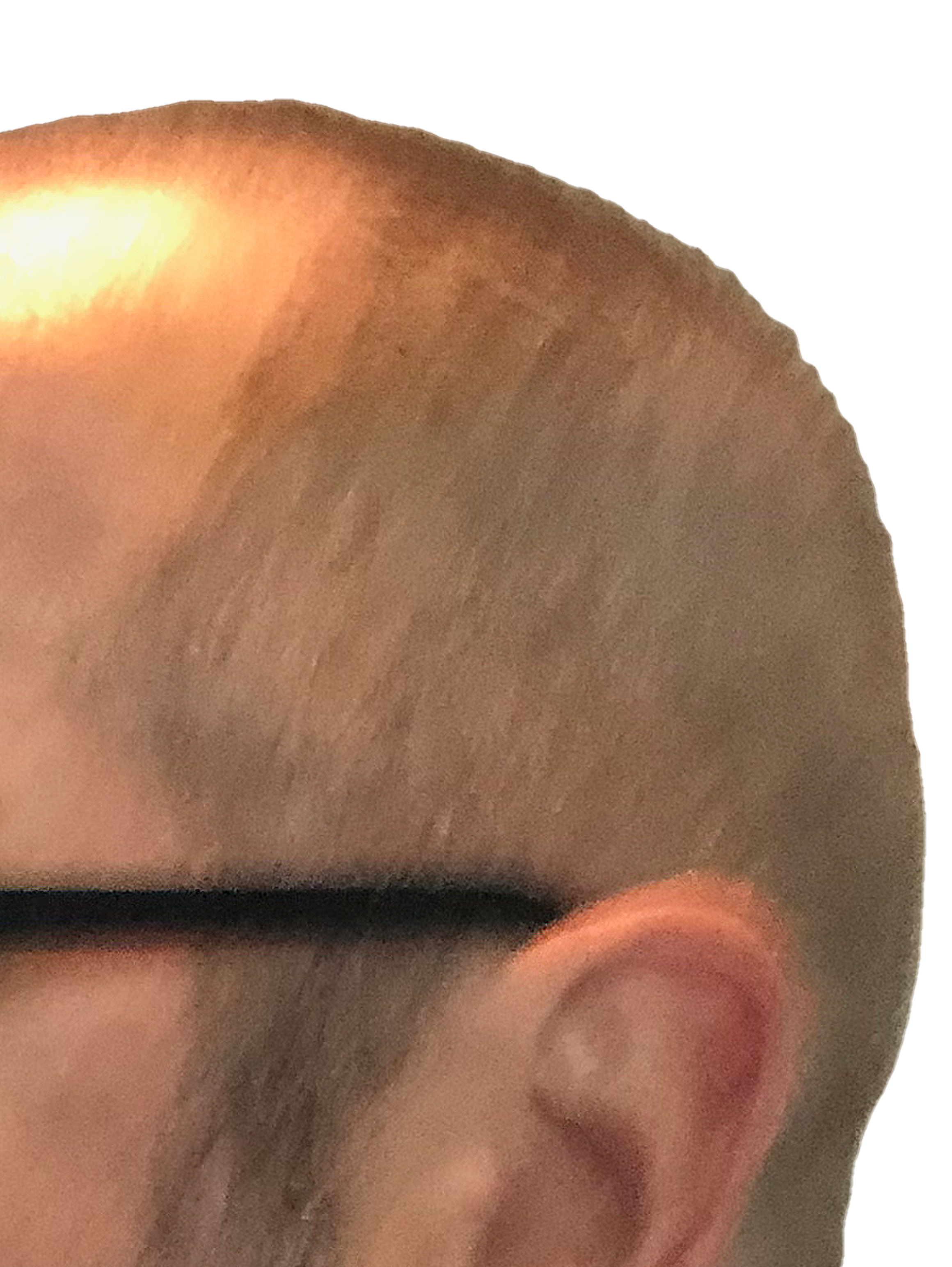 Photo of me from left side showing progress four days after hair transplant