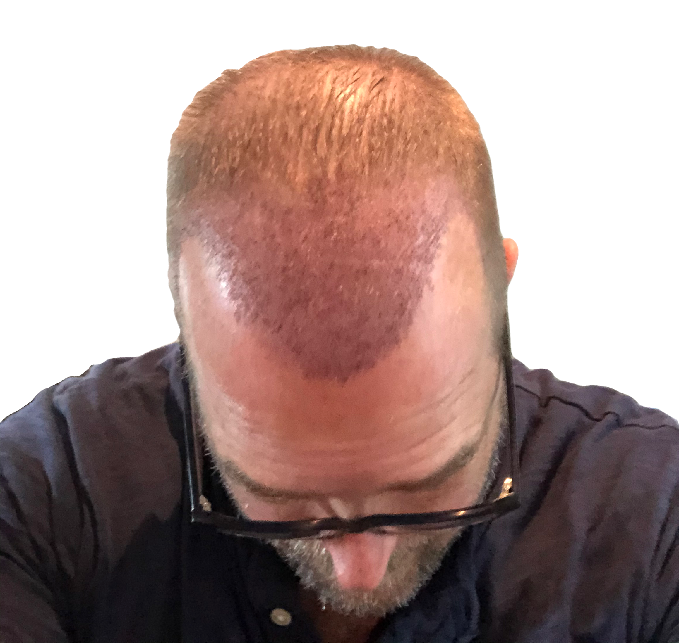 Photo of top of head showing progress four days after hair transplant
