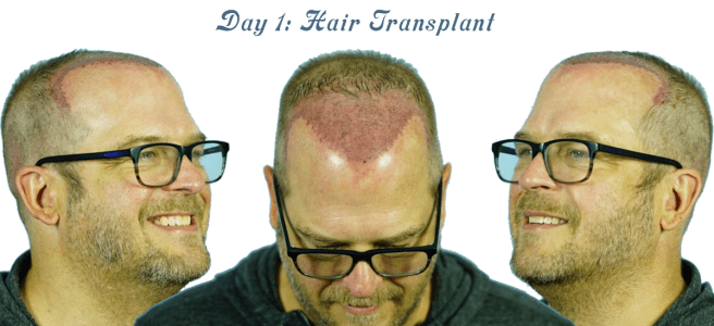 Photo showing one day after hair transplant
