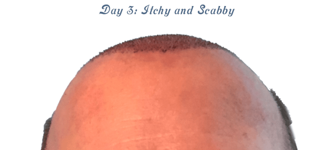 Photo showing three days after hair transplant