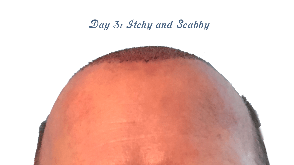 Day 3 – Itchy and Scabby&nbsp;Scalp