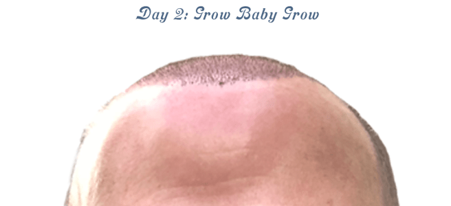 Photo showing two days after hair transplant