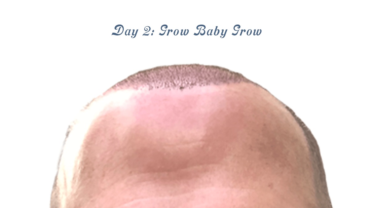 Day 2 – Managing my Hair Transplant&nbsp;Post-op