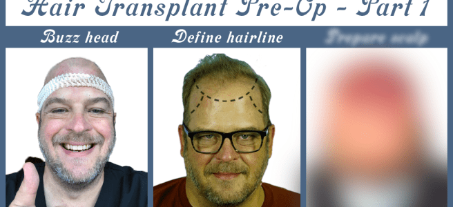 Photo of pre-op hair transplant