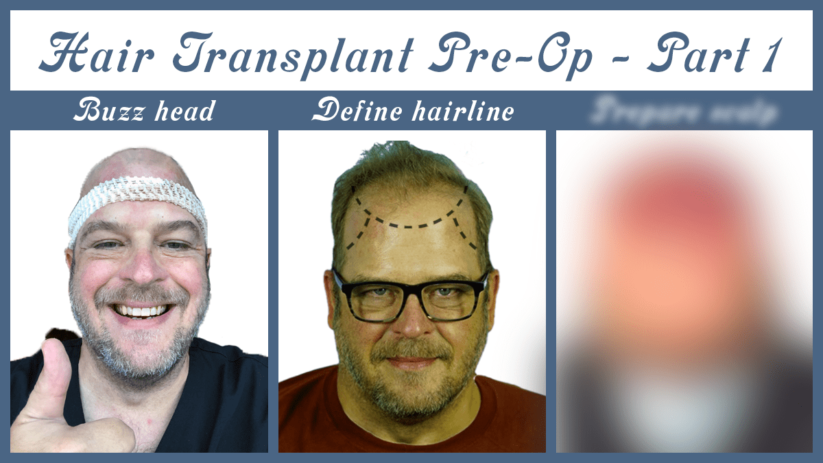 Hair Transplant Pre-op: Define Hairline, Buzz Head, Before Photos – Part&nbsp;1
