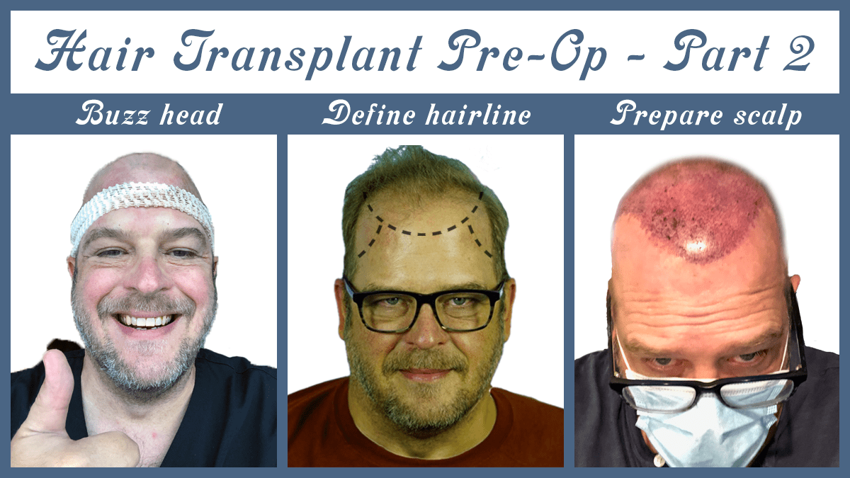 Hair Transplant Pre-op: Preparing my scalp for FUE hair transplant – Part&nbsp;2