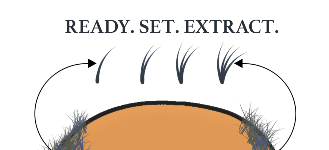 Graphic cover photo for day of FUE Hair Transplant Surgery – Part 1