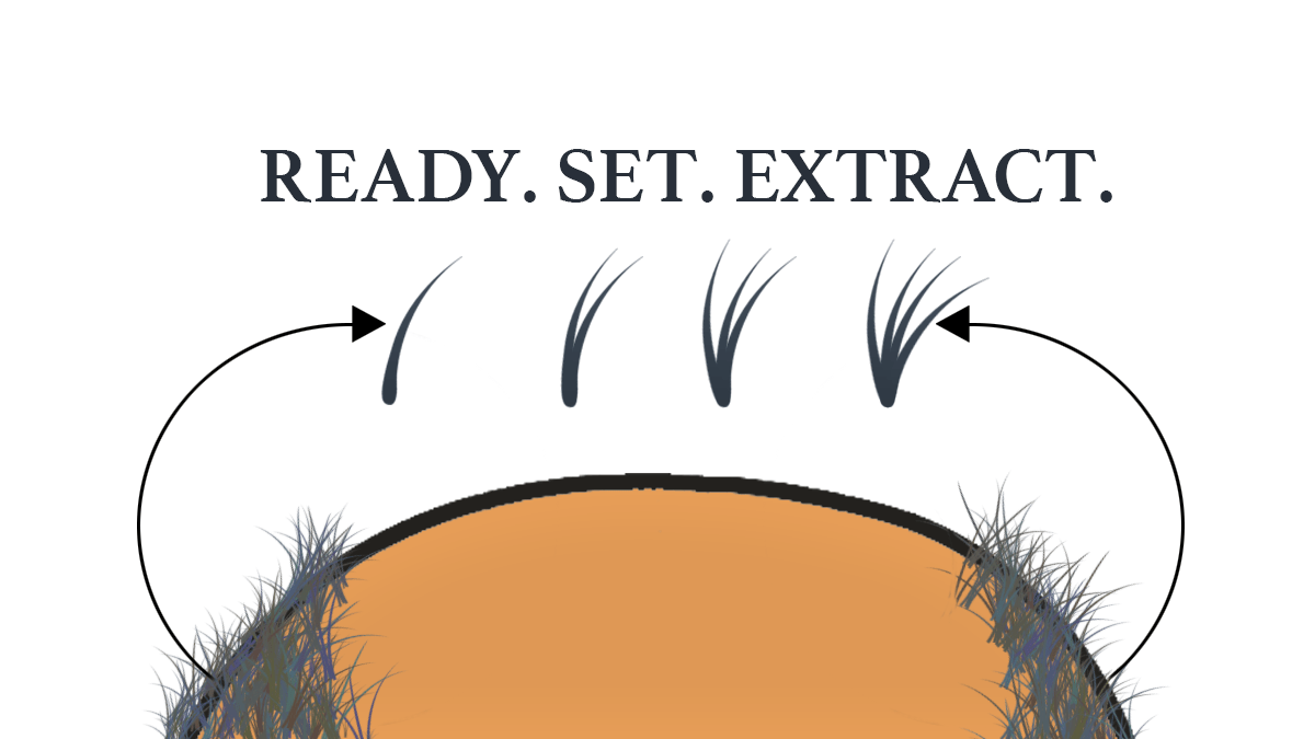 Day of FUE Hair Transplant Surgery – Part&nbsp;1