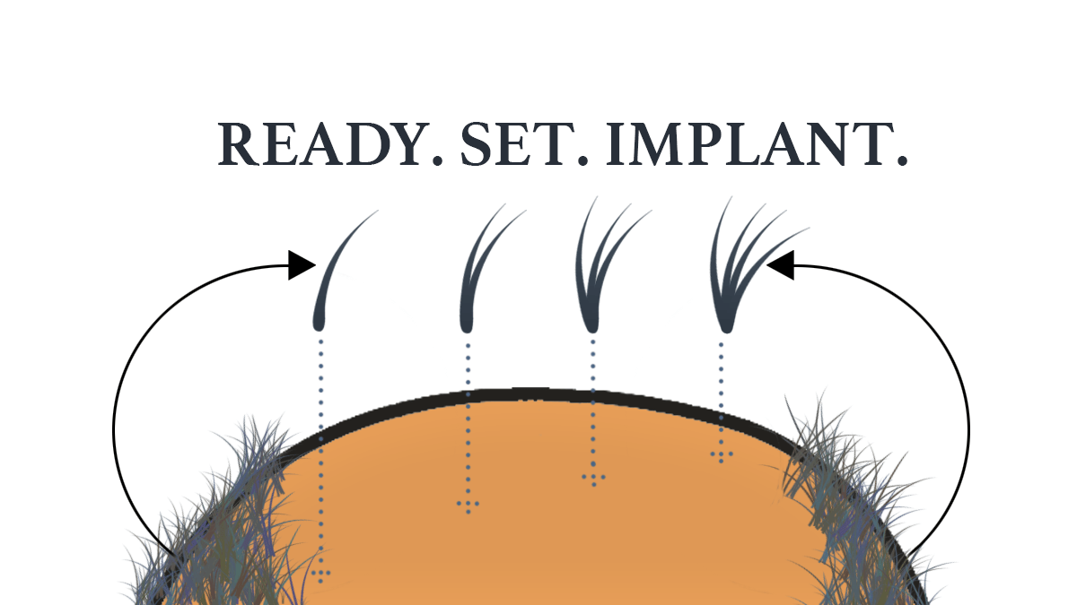 Day of FUE Hair Transplant Surgery – Part&nbsp;2