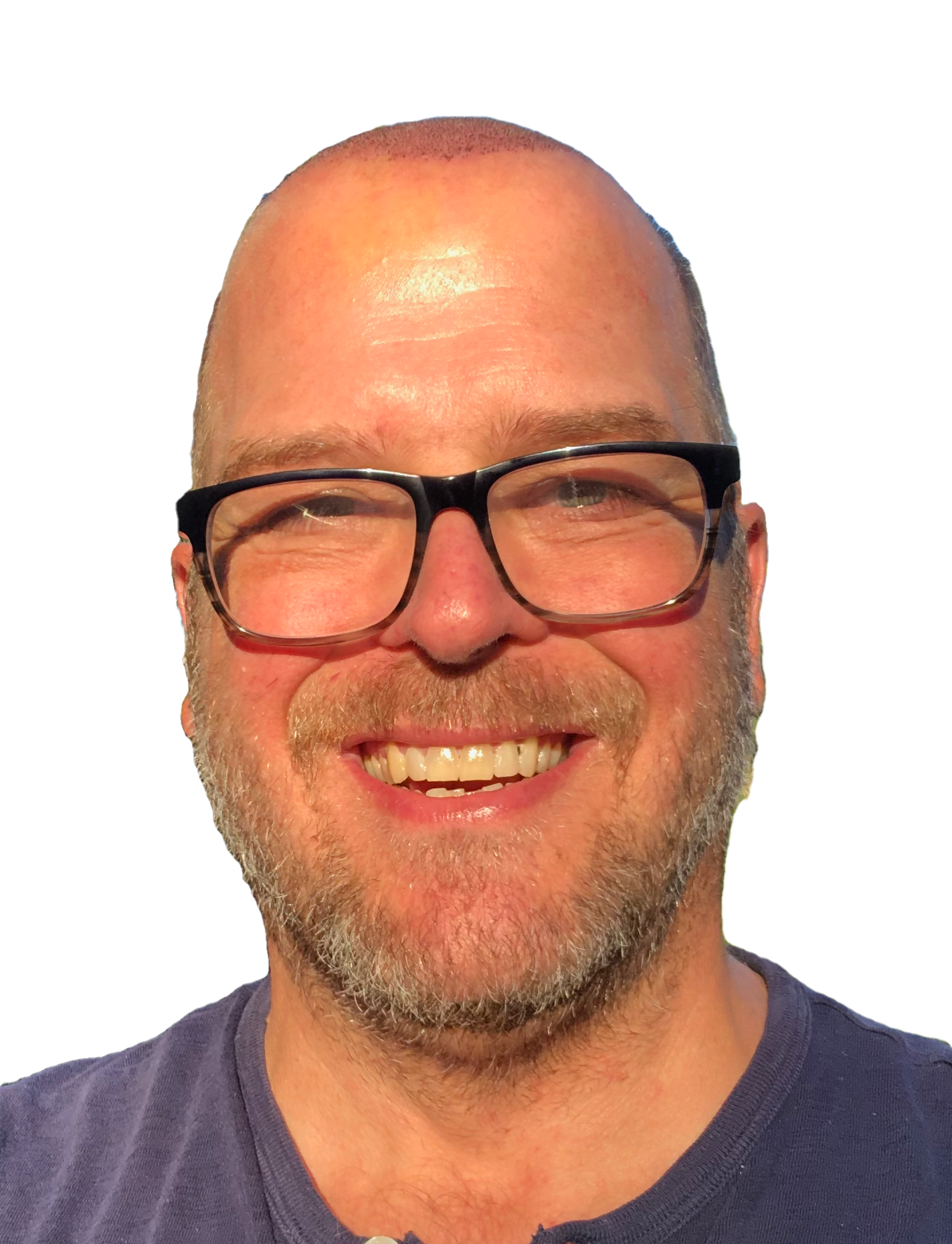 Photo of my from front showing progress five days after hair transplant