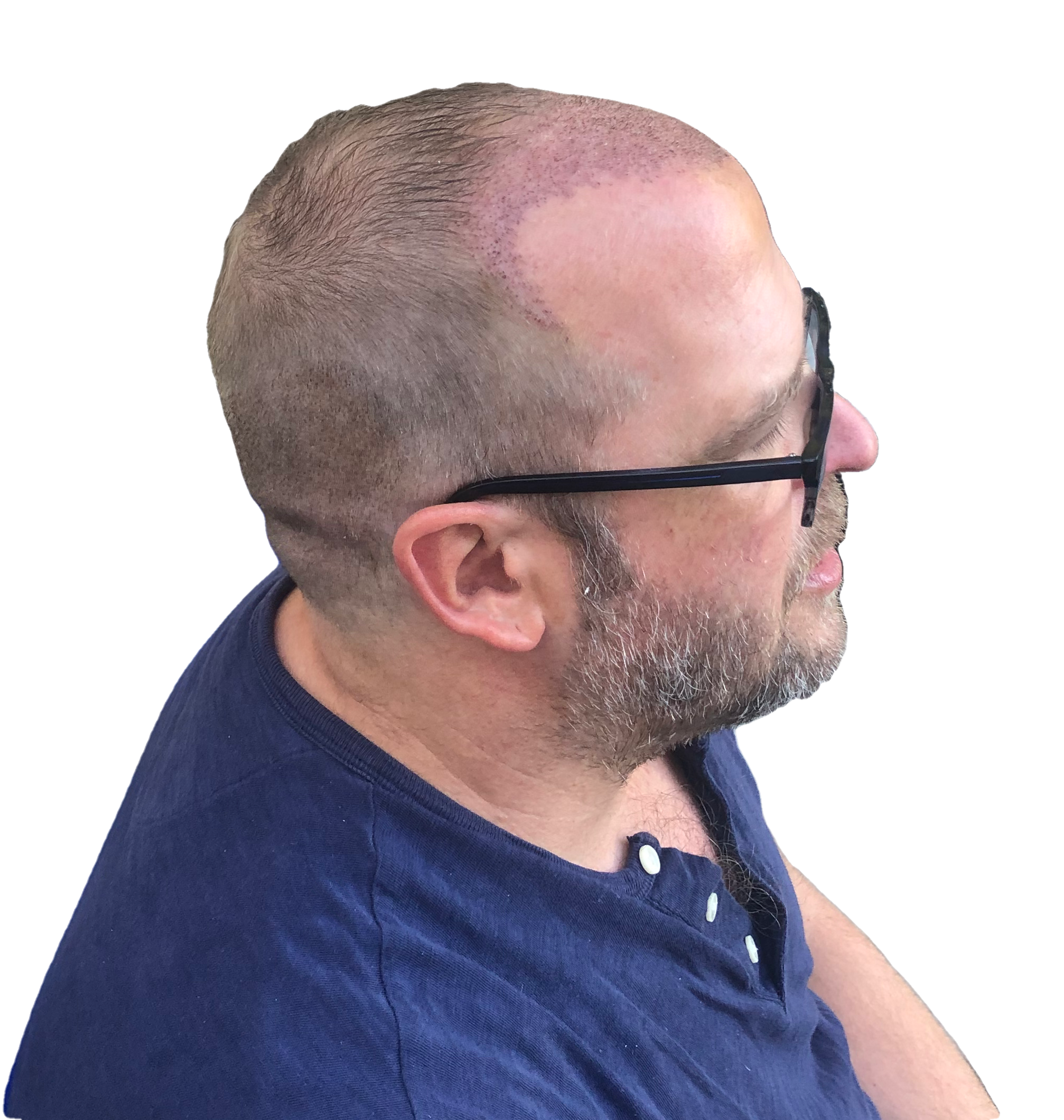 Photo of right side of head after five days from hair transplant