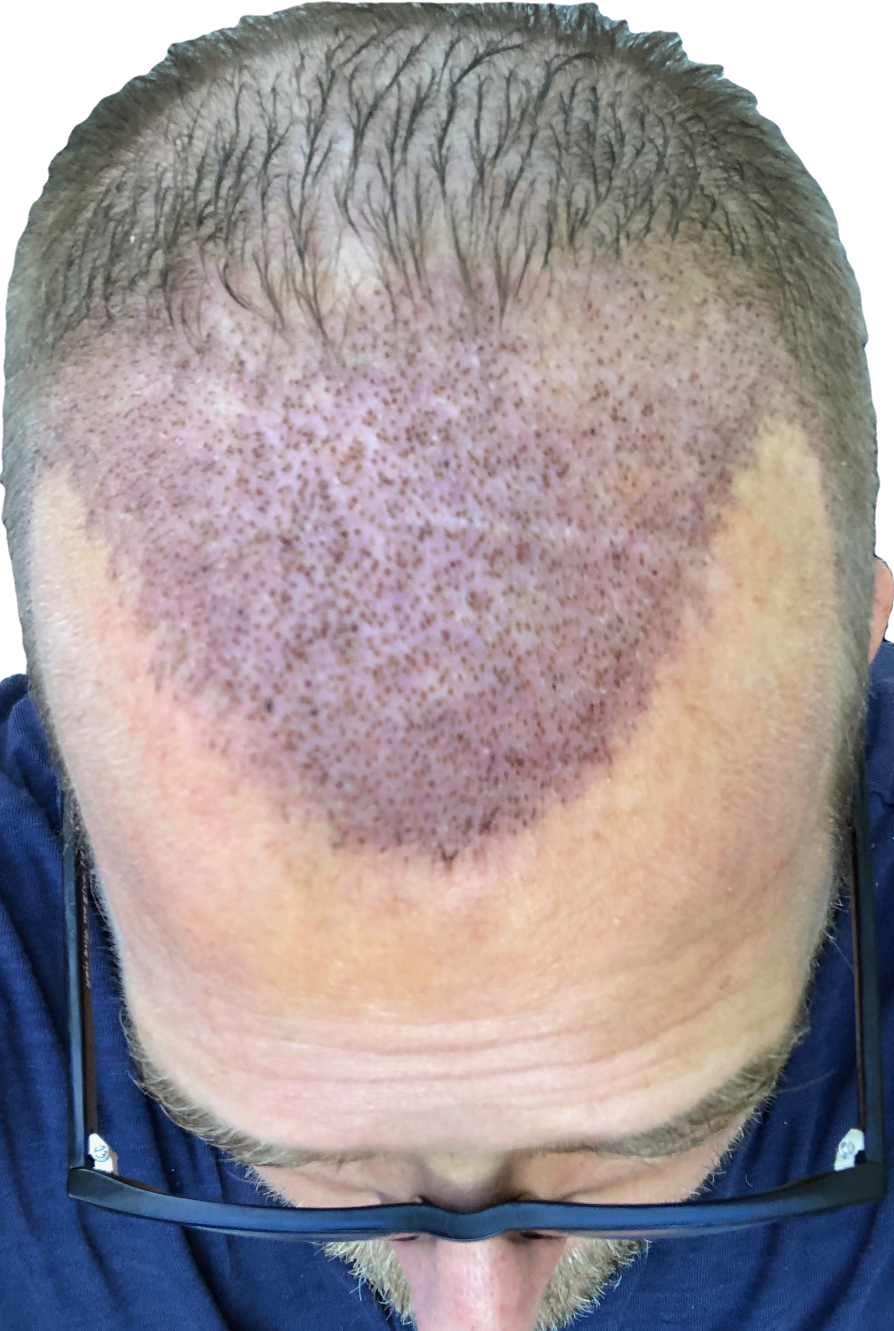 Photo top of head showing five days after hair transplant