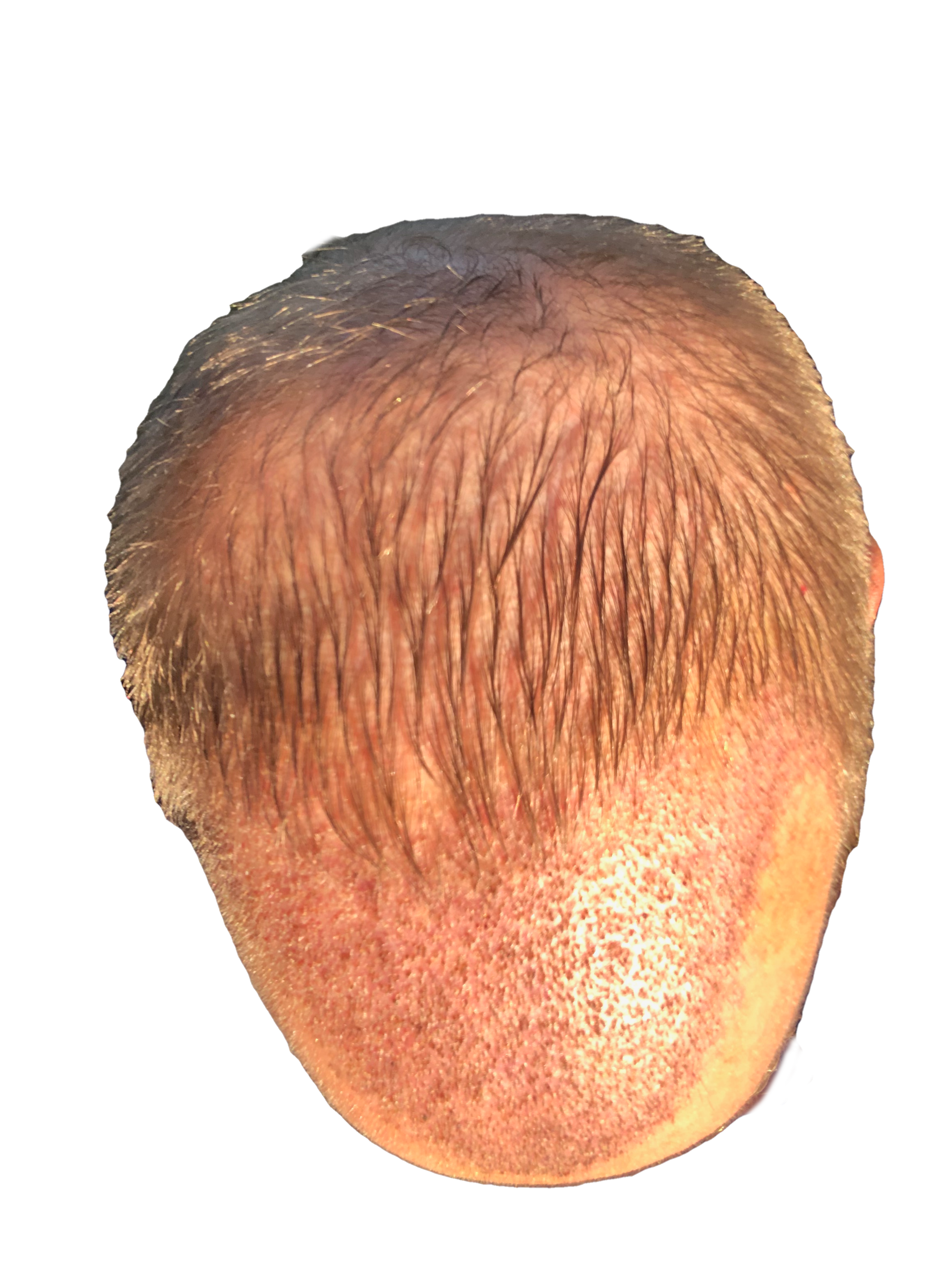 Photo top of head five days after hair transplant