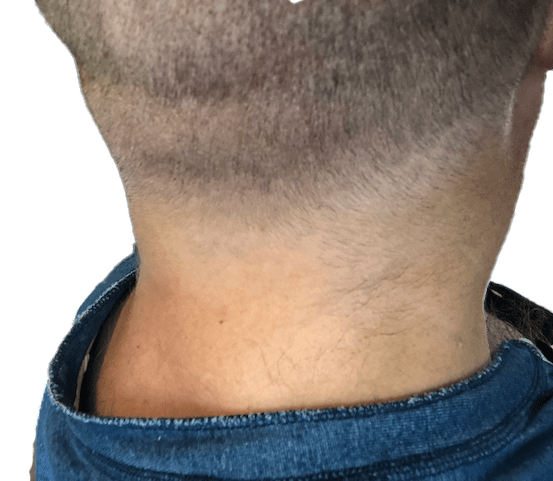 Back side of head after eight days from hair transplant