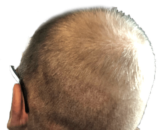 Crown of head after eight days from hair transplant