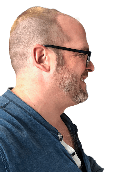 Right side of head after eight days from hair transplant