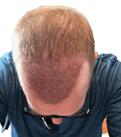 Top of head after eight days from hair transplant